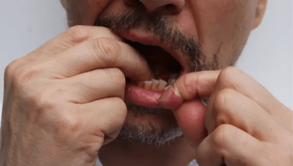 вакцинация нитью