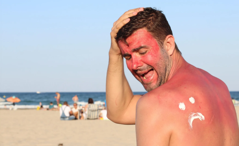солнечный ожог