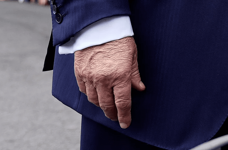 Трамп, синяк на руке