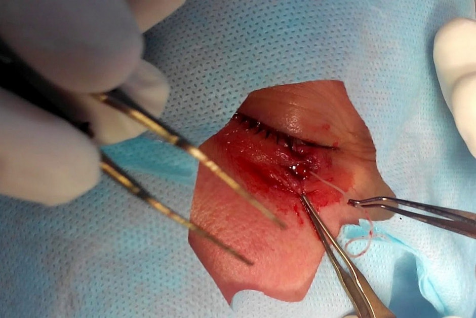 4-Удаление паразита из глаза с помощью пинцета.jpg