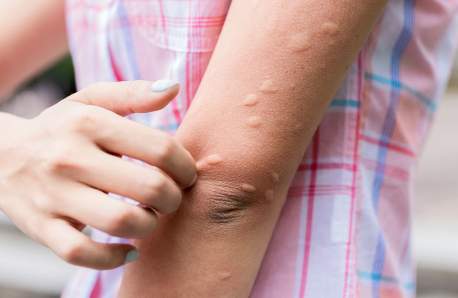 Укусы комаров на руке.jpg
