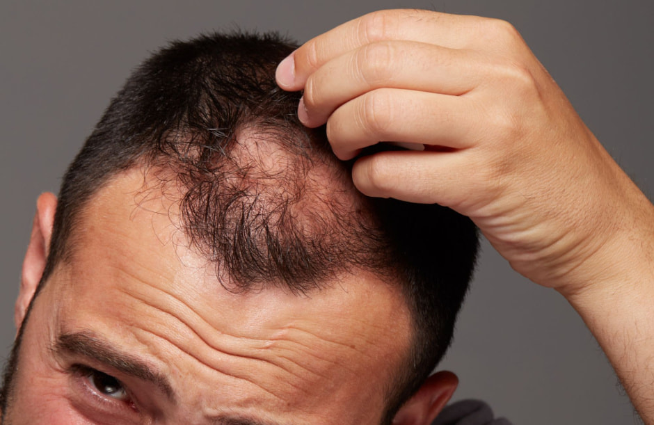 Выпадение волос_4.jpg