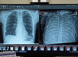 Мужчина прожил 48 часов без легких – врачи сделали невозможное