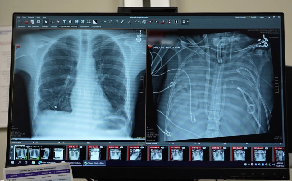 Новые легкие пациентов (слева) и старые легкие (справа)