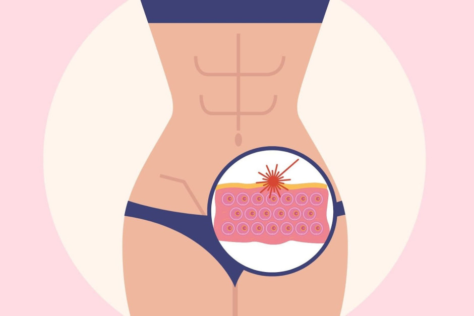 Интимное омоложение 3.jpg Интимное омоложение 3.jpg