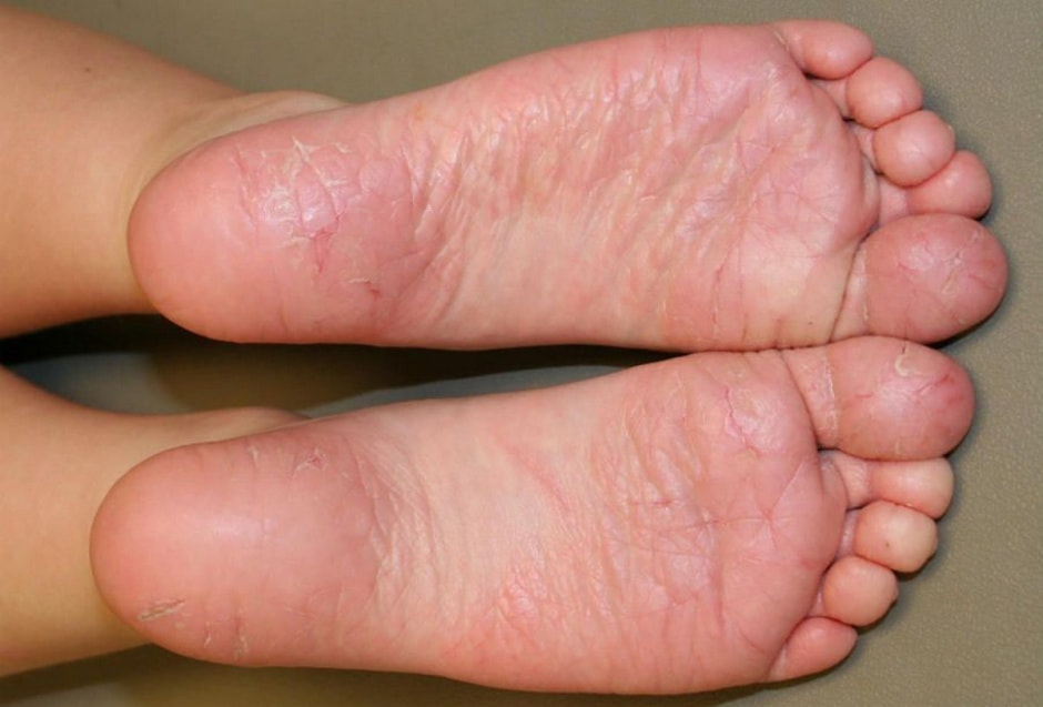 4-Шелушение и зуд пяток.jpg