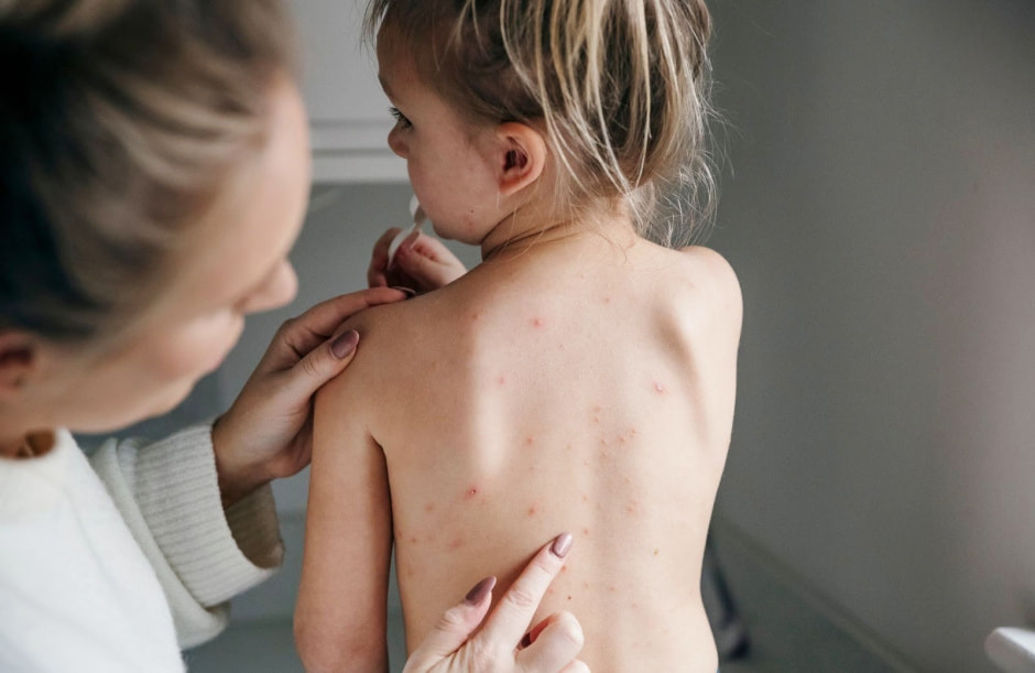 Ветрянка 2.jpg Ветрянка 2.jpg