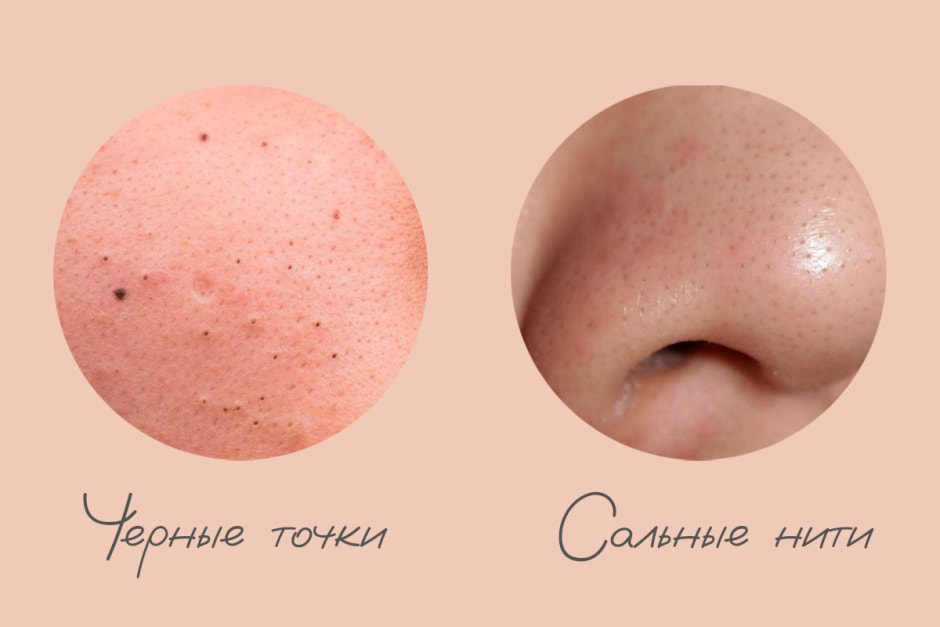 Черные точки и натуральная косметика вопросы косметологу 1.jpg