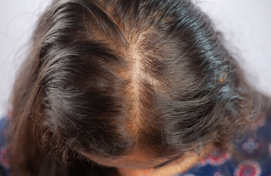 Выпадение волос_5.jpg