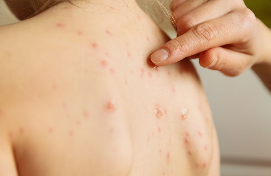 Ветрянка 5.jpg Ветрянка 5.jpg