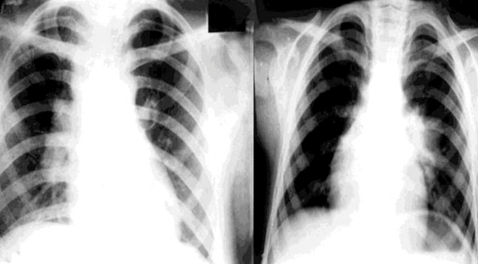 туберкулез