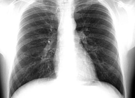 Опухоли “выключают” иммунитет через мозг: как рак лёгких обманывает организм