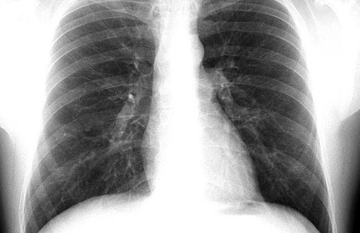 Опухоли “выключают” иммунитет через мозг: как рак лёгких обманывает организм