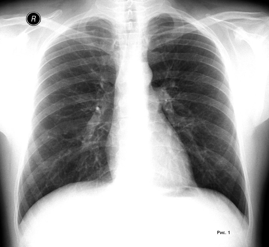 Легкие Легкие