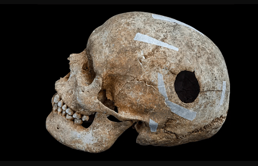 В Англии обнаружили массовое захоронение эпохи викингов с обезглавленными телами и “великаном” после трепанации мозга