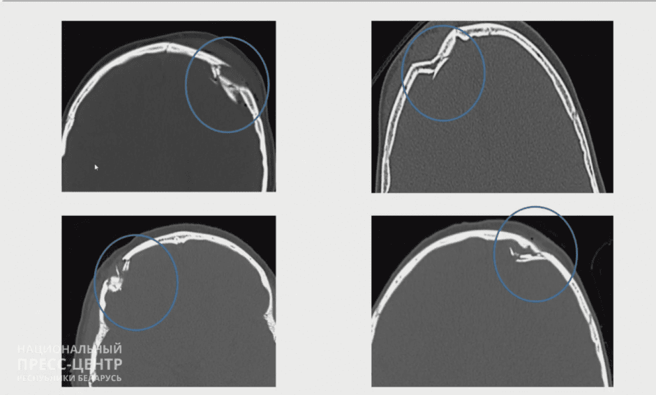 тюбинговые травмы