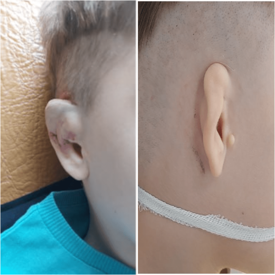 Уникальная операция на ухе