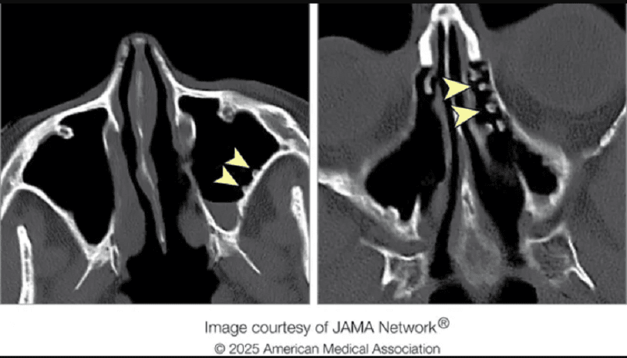 булыжники в носу