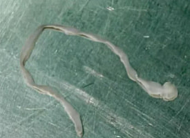 У китаянки из мозга удалили восьмисантиметрового паразита после нескольких лет странных симптомов