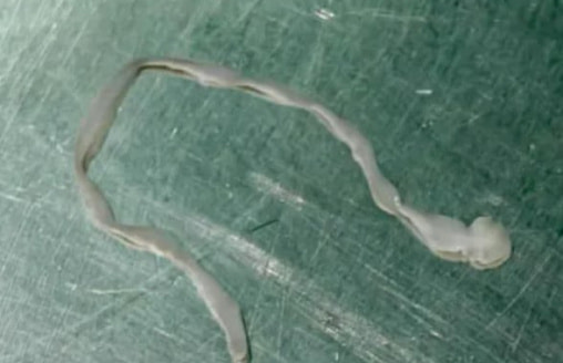 У китаянки из мозга удалили восьмисантиметрового паразита после нескольких лет странных симптомов