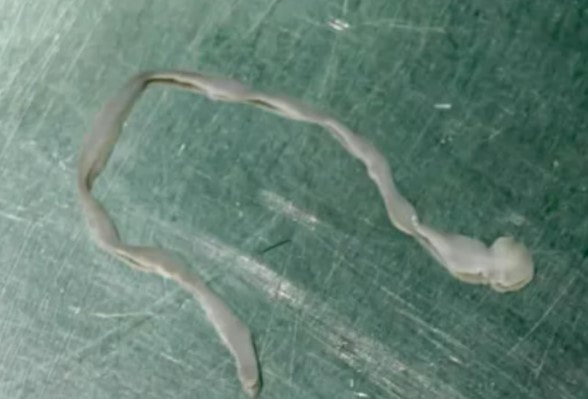 У китаянки из мозга удалили восьмисантиметрового паразита после нескольких лет странных симптомов