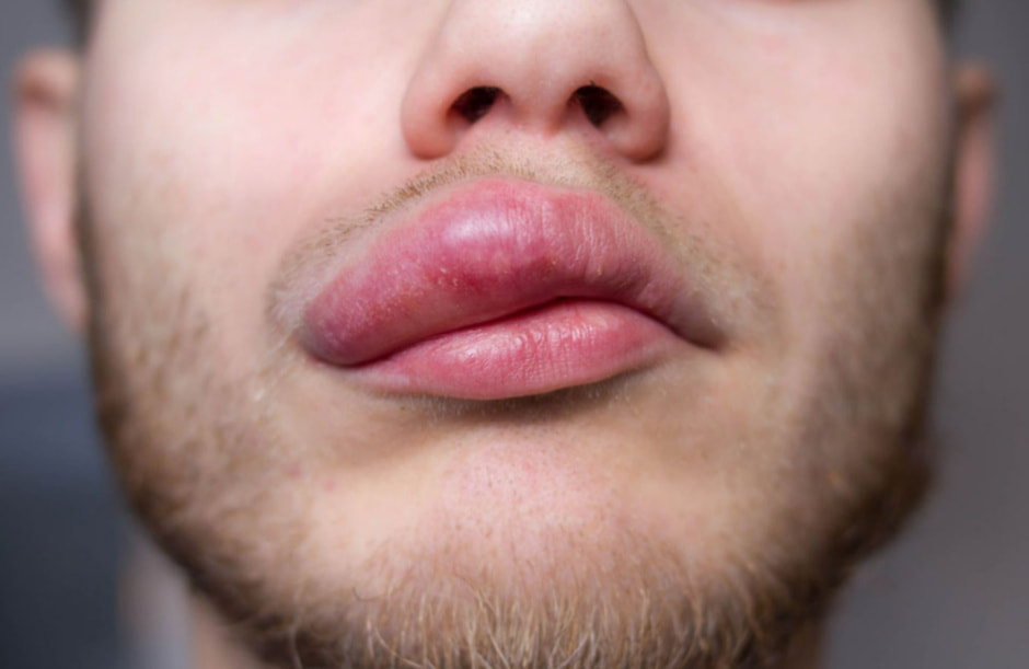 Отек губ.jpg