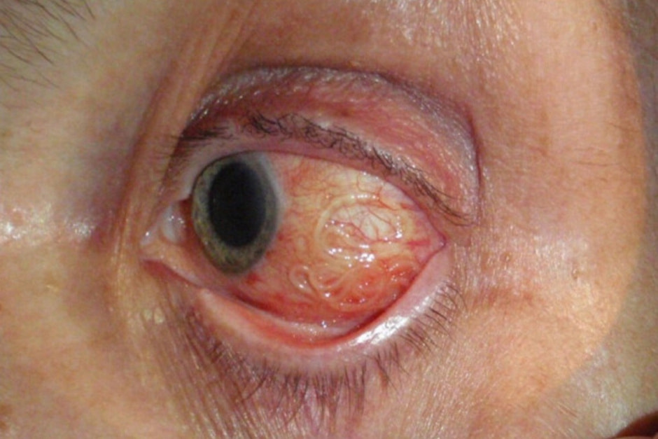 3-Расположение паразита (дирофиляриоз) в глазу.jpg