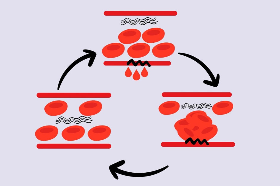 Тромбоз 2.jpg