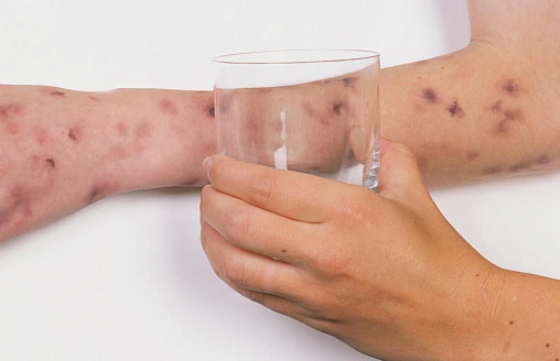 “Не ждите сыпи!” - Врач-инфекционист о том, как распознать менингит, пока не стало поздно